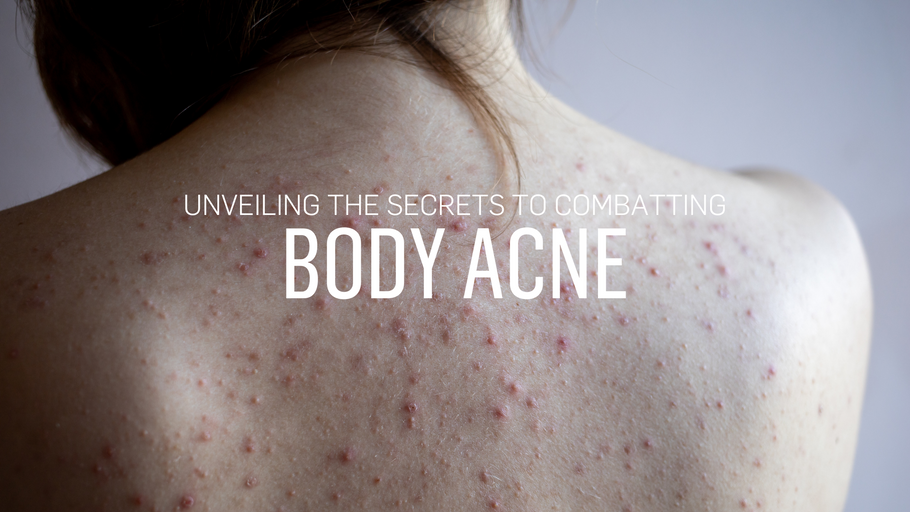 Unveiling the Secrets to Combatting Body Acne