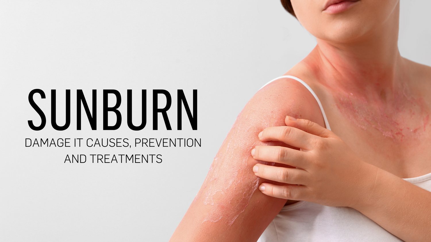 Understanding Sunburn: Damage It Causes, Prevention and Treatments