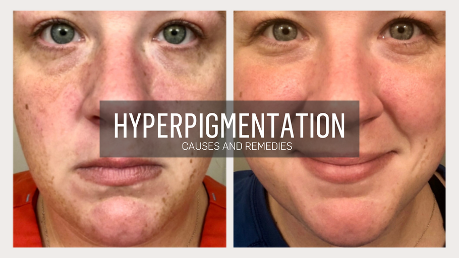 Hyperpigmentation - Causes and Remedies